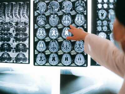 medical professional looking at brain scans of a patient